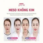 Meso không kim là gì? Ưu nhược điểm khi cấy meso không kim